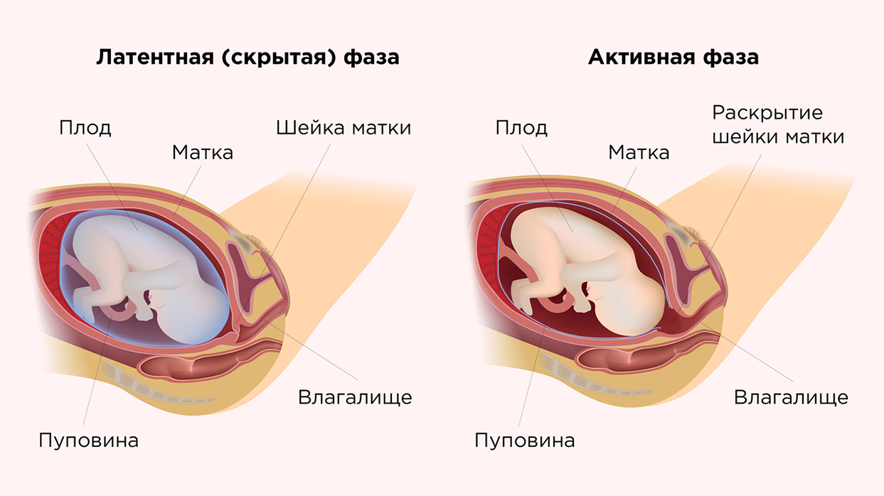 Раскрытие шейки матки.
