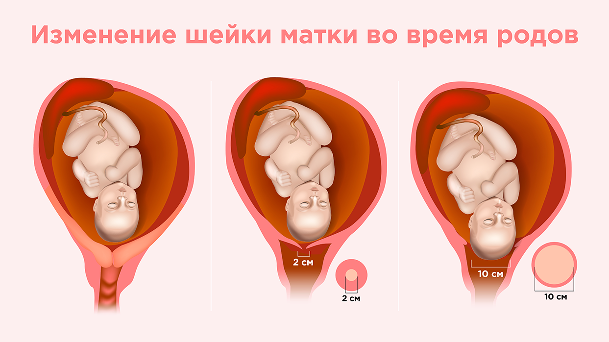 Изменение шейки матки во время родов.