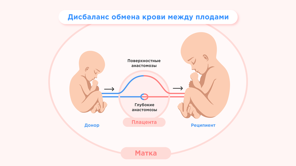 Дисбаланс обмена крови между плодами.