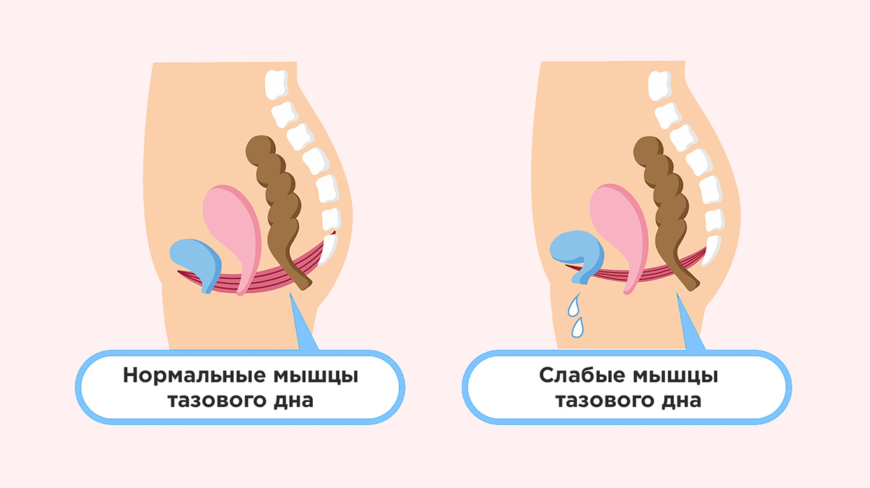 Интимное восстановление после родов.