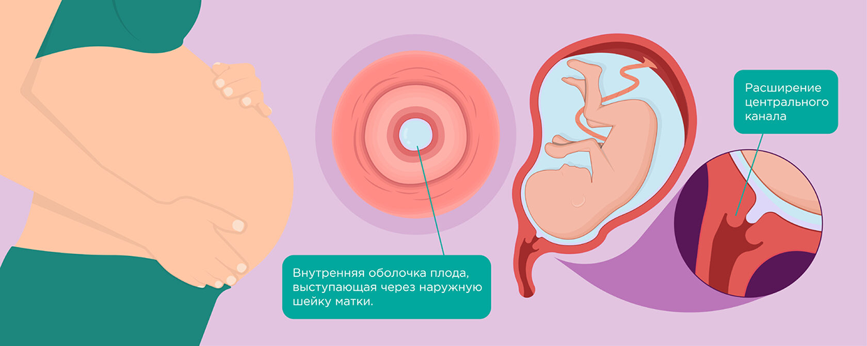 Истмико-цервикальная недостаточность.
