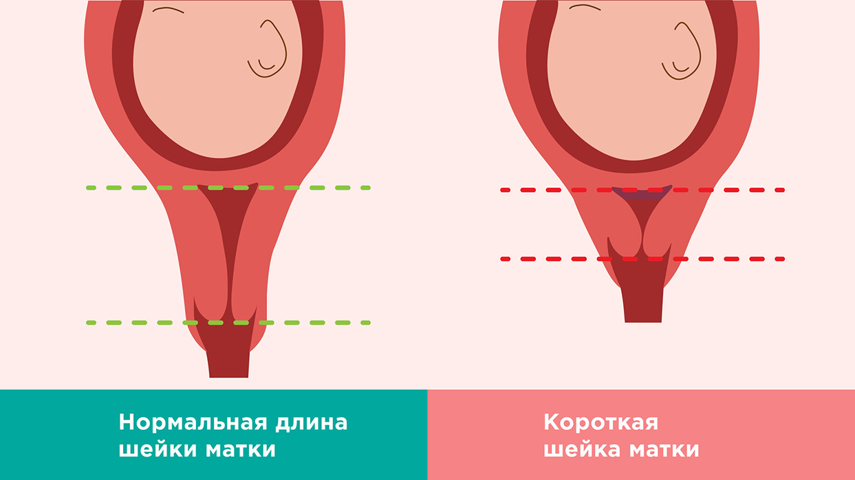 Причины возникновения истмико-цервикальной недостаточности.