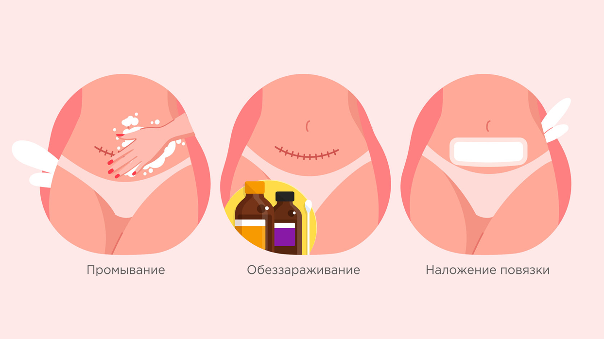 Как обрабатывать шов после кесарева сечения?