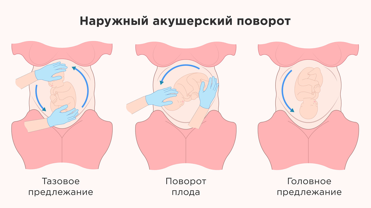Как проводится наружный акушерский поворот плода.