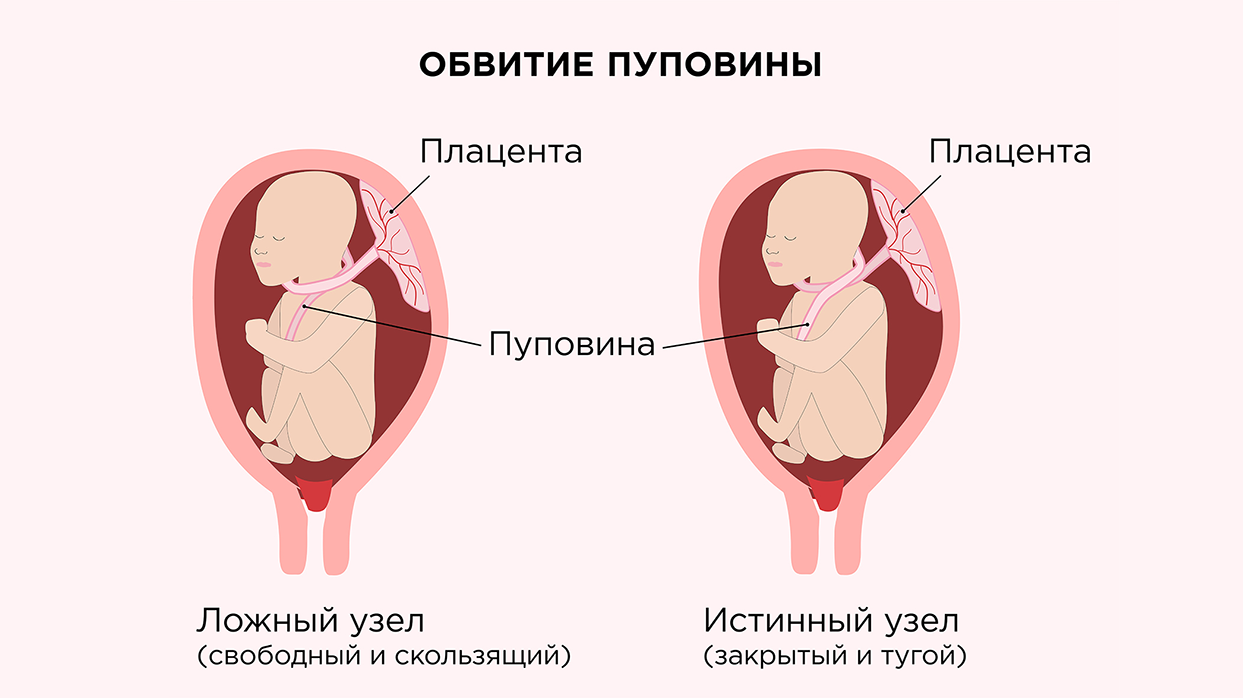 Обвитие пуповиной при беременности.