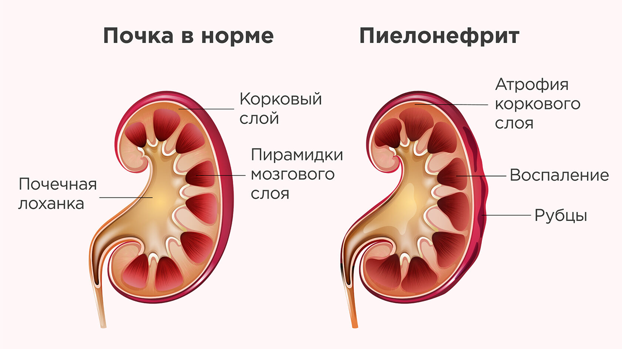 Признаки пиелонефрита у беременных.