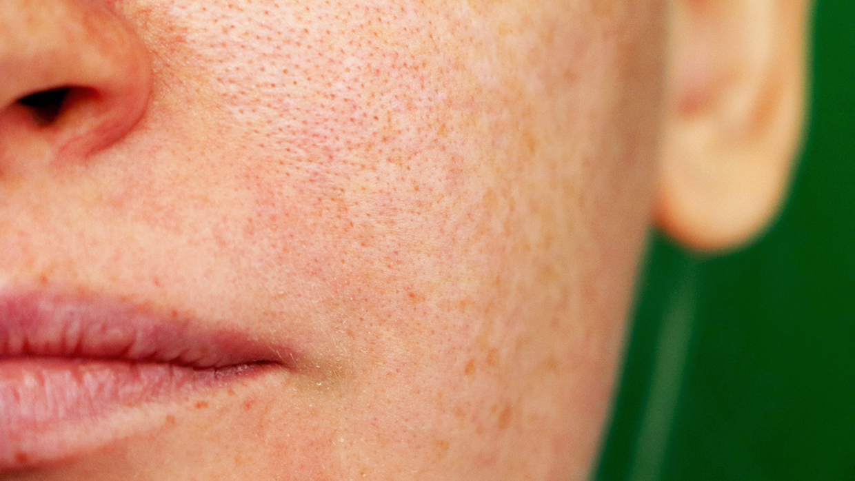 Проблемы с кожей во время беременности.