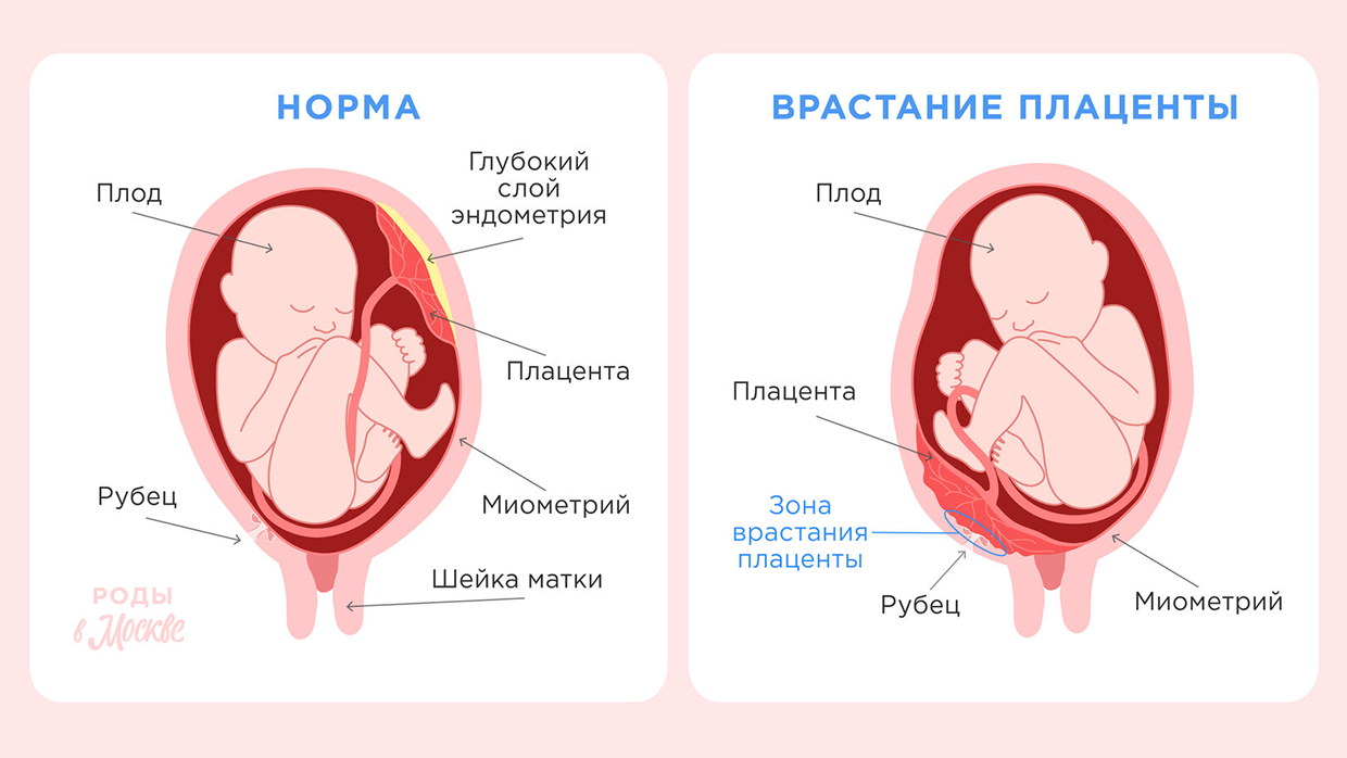 Роды с врастанием плаценты.